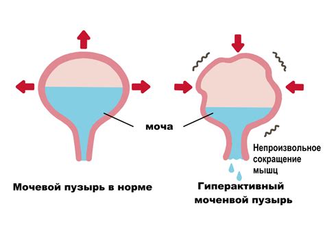 Роль содержимого гомогенного в мочевом пузыре