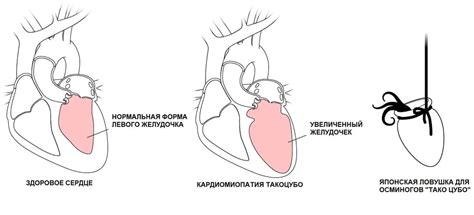 Роль стресса в возникновении ларингоспазма