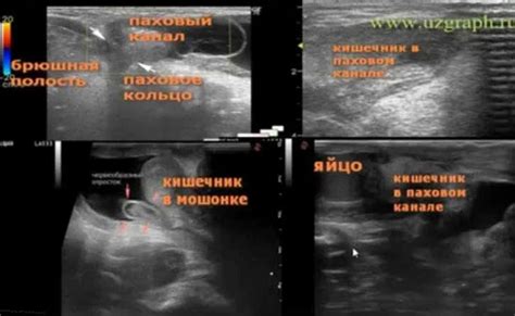 Самопальные тесты для диагностики грыжи