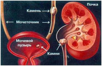 Связь между мочевой кислотой и заболеваниями почек