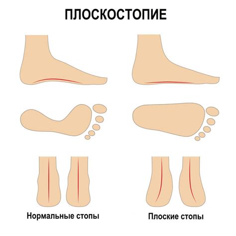 Связь пяточной шпоры с плоскостопием и другими причинами