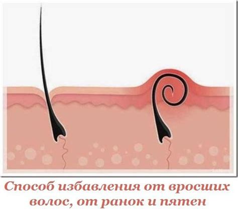 Секреты эффективного избавления от вросших волос после шугаринга