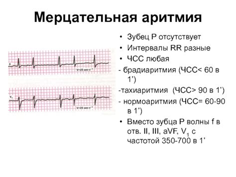 Симптоматика мерцательной аритмии на электрокардиограмме