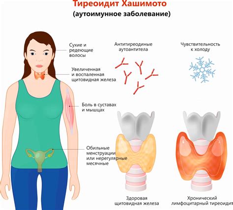 Симптомы аутоиммунного воспаления щитовидной железы