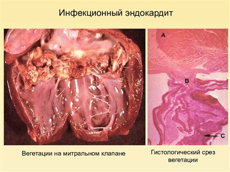 Симптомы бактериального эндокардита у женщин