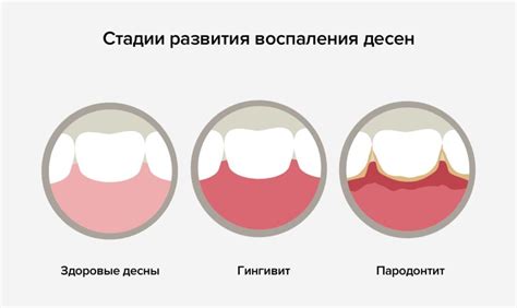 Симптомы воспаления десен и его причины