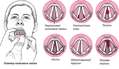 Симптомы голосовых изменений