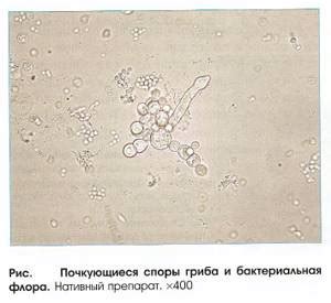 Симптомы дрожжевых клеток в моче