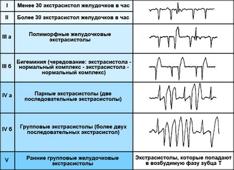 Симптомы желудочковой экстрасистолии по типу тригеминии