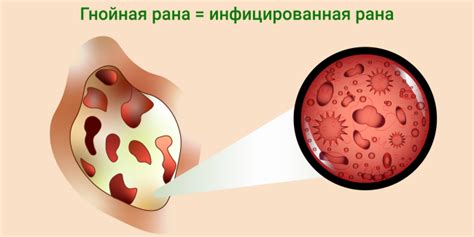 Симптомы инфекции раны и как им предотвратить