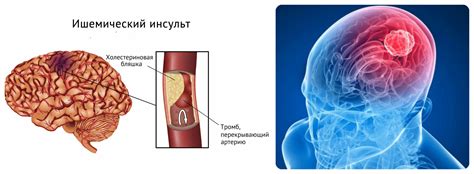 Симптомы ишемии левого полушария головного мозга