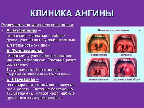 Симптомы и диагностика мицелия гриба в горле