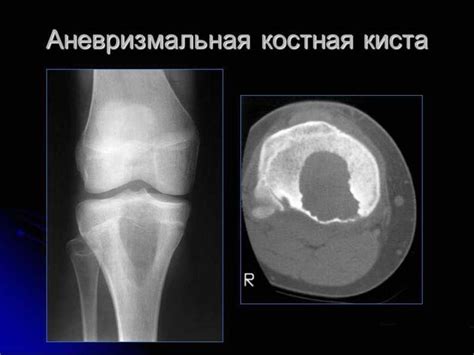 Симптомы и диагностика нароста на бедренной кости