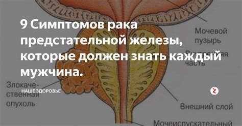 Симптомы и признаки узла в предстательной железе