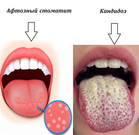 Симптомы и причины вязкости во рту