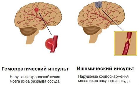 Симптомы и причины разрыва сосуда в веке