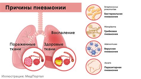 Симптомы и причины тяжелого дыхания при пневмонии