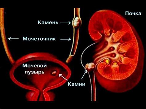 Симптомы камня в мочеточнике