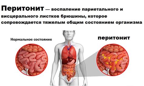 Симптомы кистозного перитонита