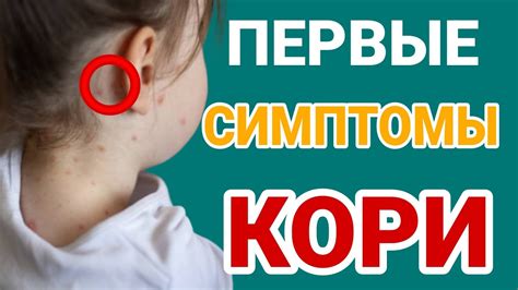 Симптомы кори у взрослых и детей