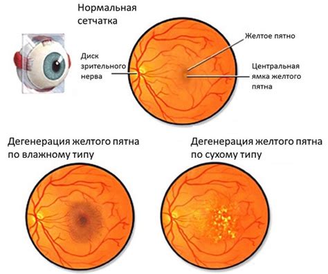 Симптомы макулодистрофии сетчатки