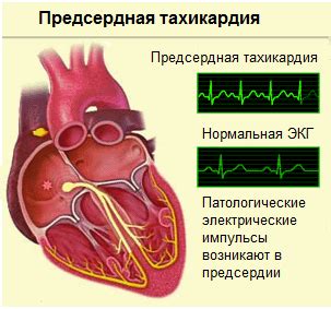 Симптомы наджелудочковой аритмии