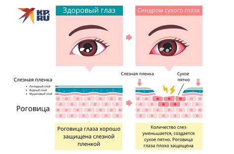 Симптомы остегматии глаза у взрослых