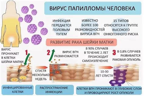 Симптомы папилломавируса 58 типа