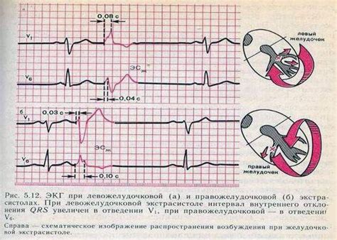 Симптомы ранней желудочковой экстрасистолии