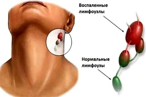 Симптомы растяжек на шее