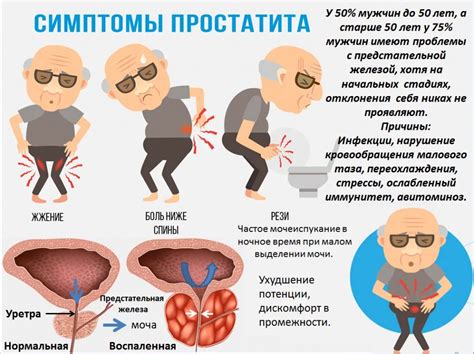 Симптомы уплотнения в простате у мужчин