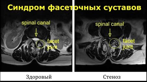 Симптомы фасеточного синдрома