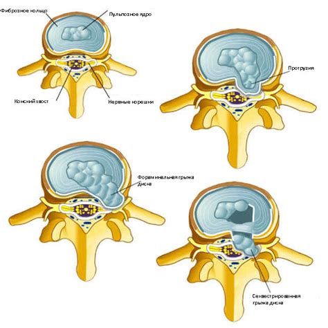 Симптомы циркулярного пролабирования межпозвонковых дисков