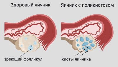 Симптомы эндометрия атрофического