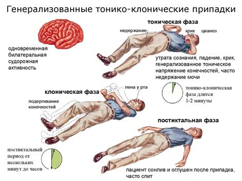 Симптомы эпилепсии у взрослых