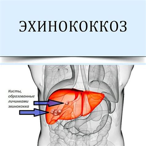 Симптомы эхинококкоза у человека