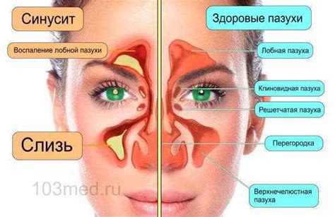 Синусит и другие проблемы с носовыми пазухами