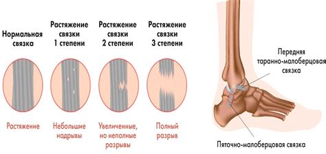 Слишком сильное растяжение или сжатие браслета