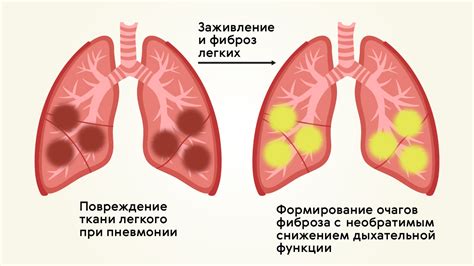 Снижение воспаления легких и бронхов