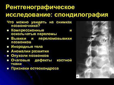 Спондилография - метод исследования позвоночника