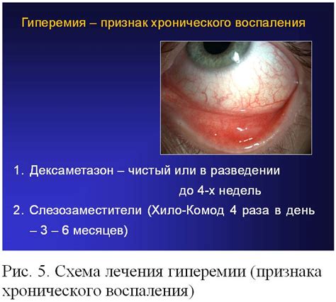 Способы лечения гиперемии