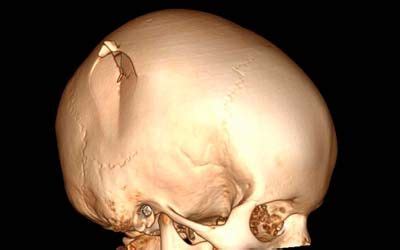 Способы предотвращения и лечения мягких костей черепа