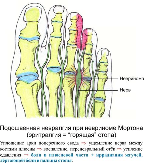 Способы предотвращения сводов ног