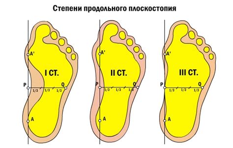 Степень запущенности плоскостопия: как выбрать упражнения