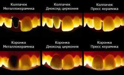 Стоимость керамики и металлокерамики