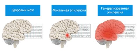 Судорожные приступы и эпилепсия