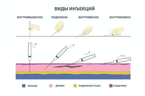 Техника выполнения инъекции