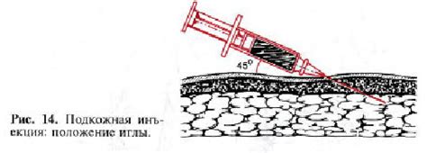 Техника проведения инъекции в бедро