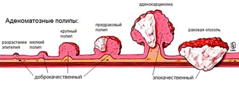 Типы опухолей в прямой кишке