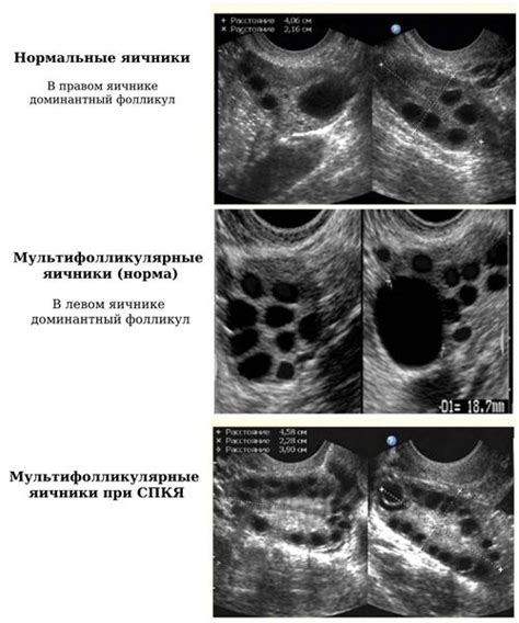 УЗИ яичников и оценка количества антральных фолликулов